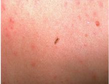 body lice pictures symptoms